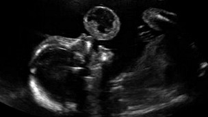     

:	120624003425_foetus_womb_304x171_s_nocredit.jpg
:	24
:	11.1 
:	328877